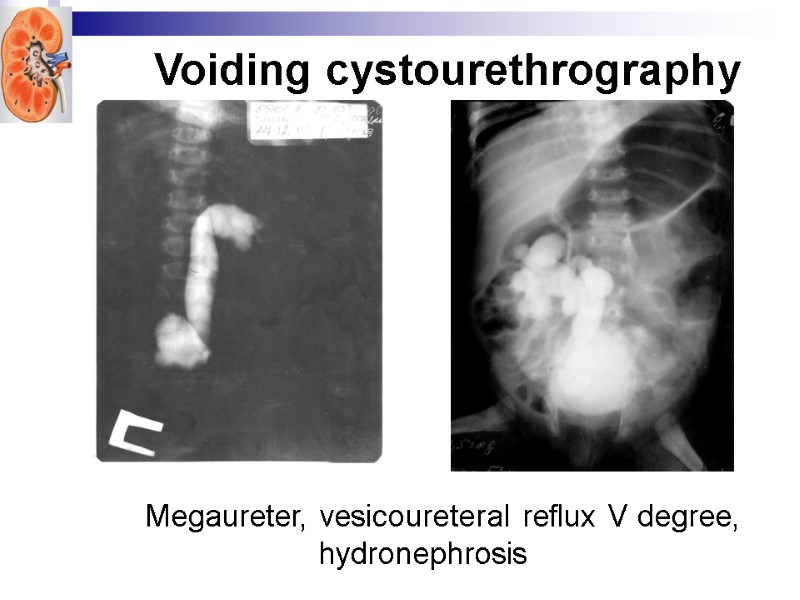 Megaureter, vesicoureteral reflux V degree, hydronephrosis Voiding cystourethrography
